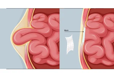 Graphic of an absorbable mesh to treat hernia