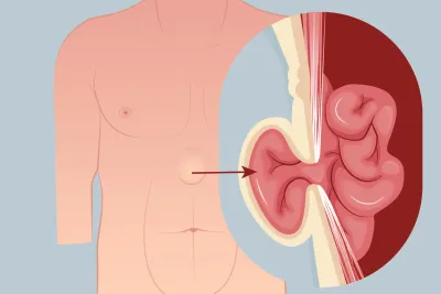 Graphic of an epigastric hernia