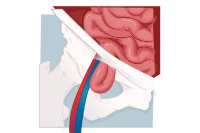Graphic of a femoral hernia