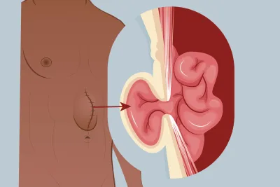 Graphic of an incisional hernia