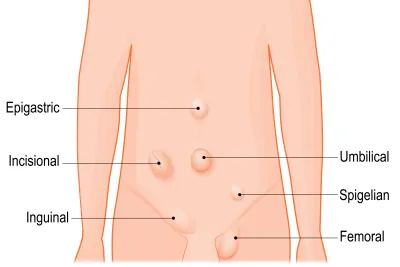Common types of hernias: Epigastric, Incisional, Inguinal, Umbilical, Spigelian and Femoral