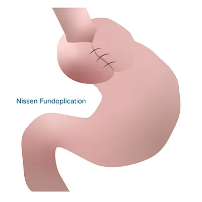 Graphic of a Nissen Fundoplication.