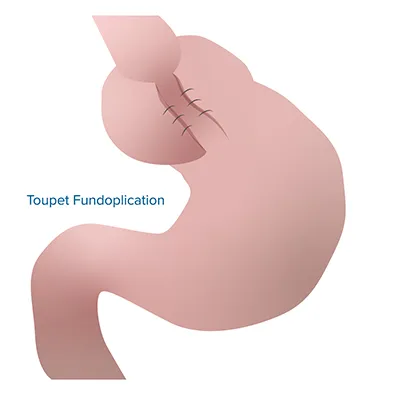 Graphic of a Toupet Fundoplication.