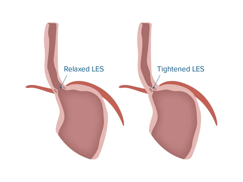 Graphic of a relaxed LES and a tightened LES.