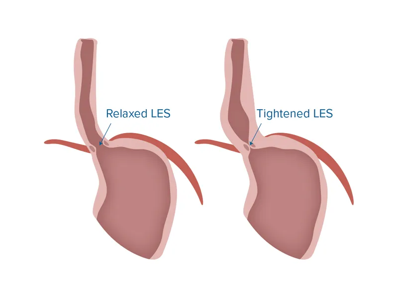 Graphic of a relaxed lower esophageal sphincter and a tightened lower esophageal sphincter.