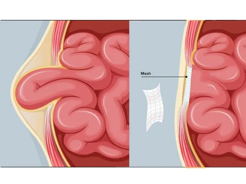 Graphic of an absorbable mesh to treat hernia