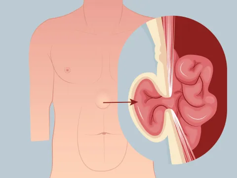 Graphic of an epigastric hernia