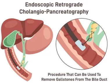 ERCP