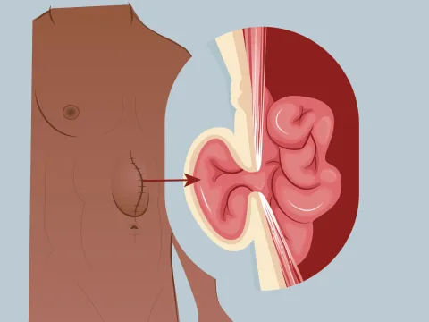Graphic of an incisional hernia