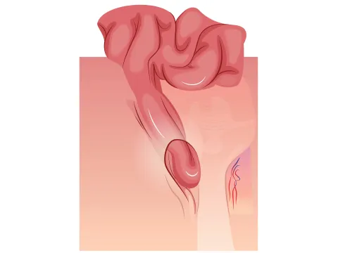 Graphic of an inguinal hernia
