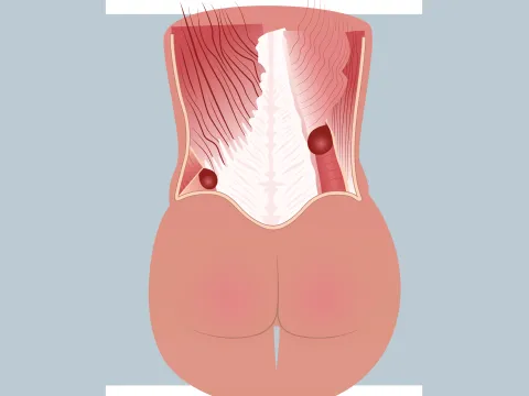 Graphic of a lumbar hernia