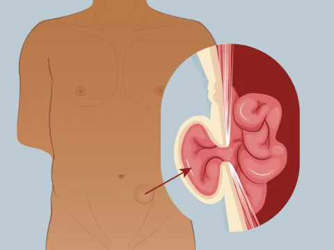 Graphic of a spigelian hernia