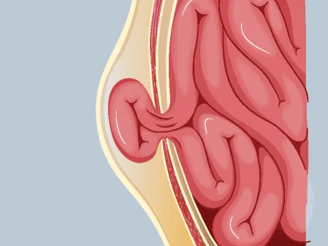 Graphic of a strangulated hernia