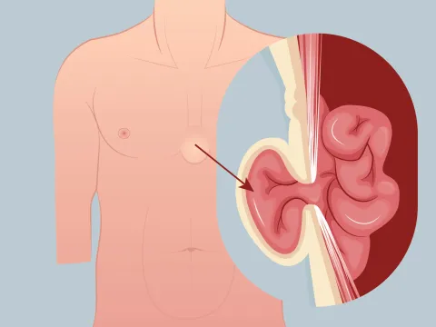 Graphic of a subxiphoid hernia