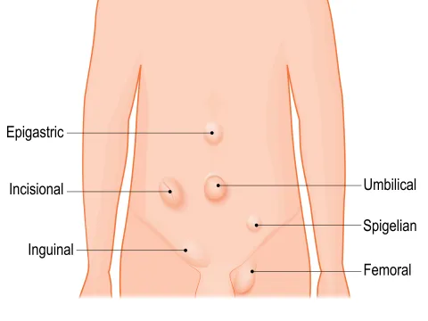 Common types of hernias: Epigastric, Incisional, Inguinal, Umbilical, Spigelian and Femoral