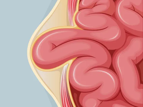 Graphic of an umbilical hernia