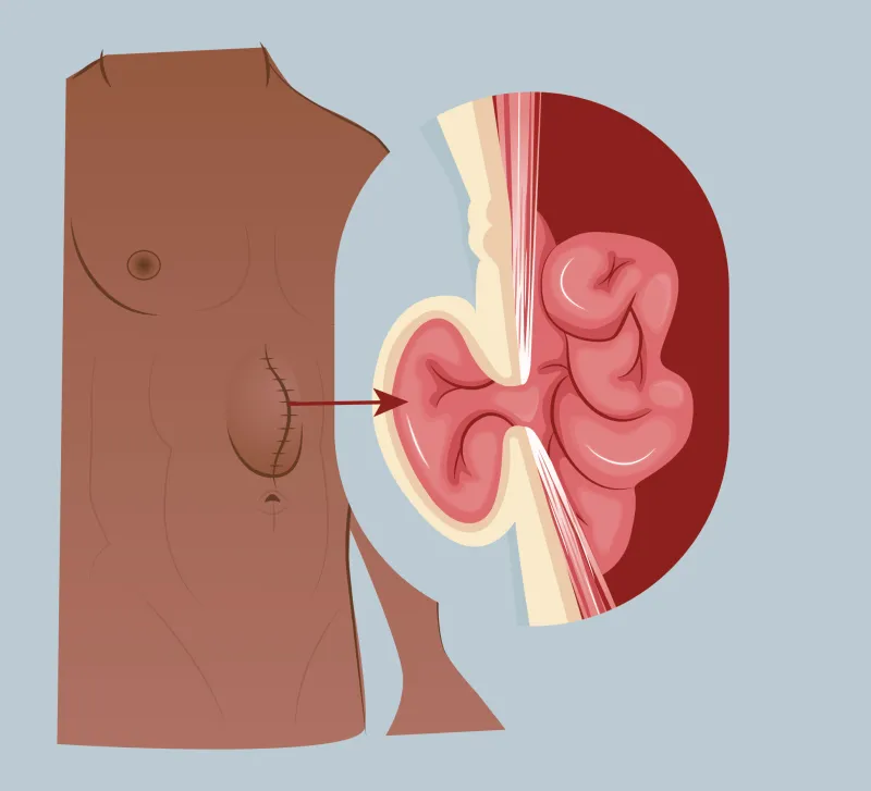 Graphic of an incisional hernia
