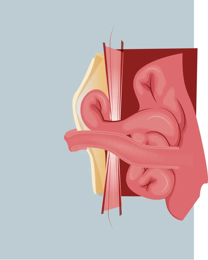 Graphic of a parastomal hernia