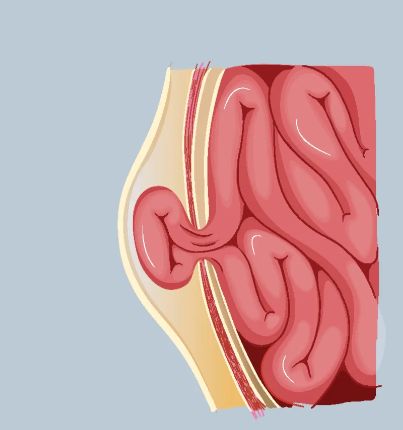 Graphic of a strangulated hernia