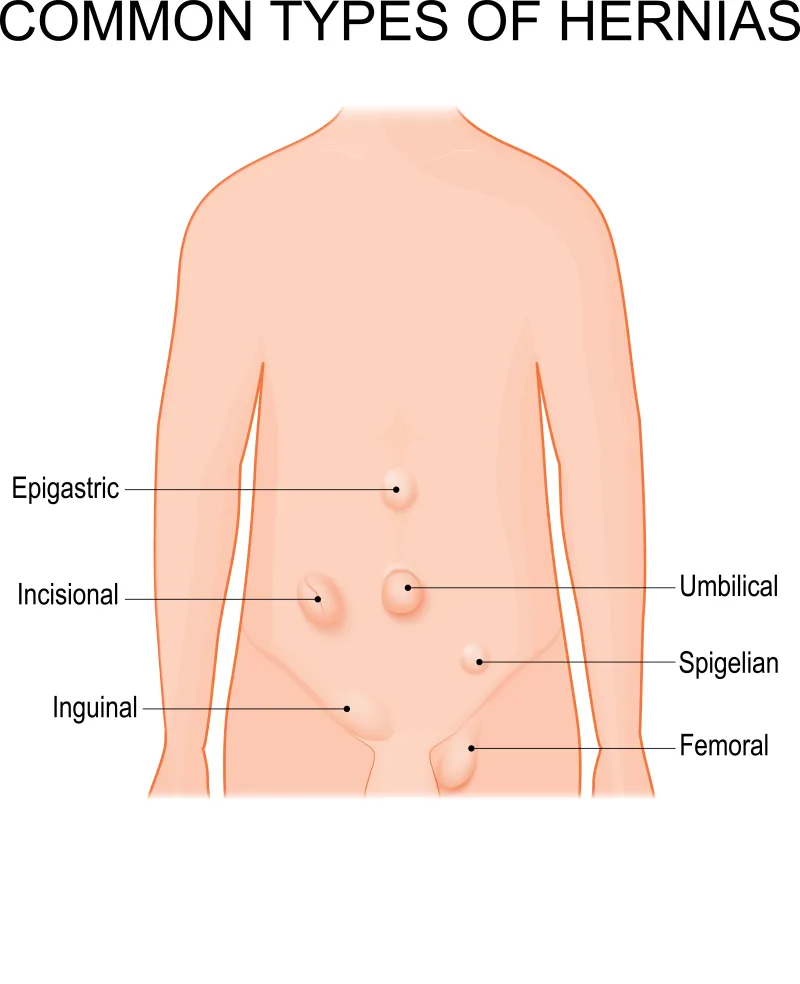 Common types of hernias: Epigastric, Incisional, Inguinal, Umbilical, Spigelian and Femoral